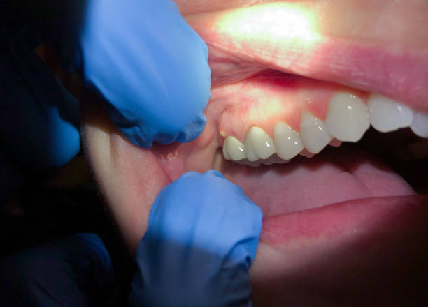 Best Emergency Broken Tooth Repair in Port Aransas, TX