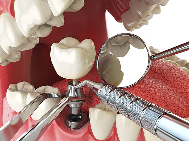 Best Emergency Tooth Extraction in Port Aransas, TX